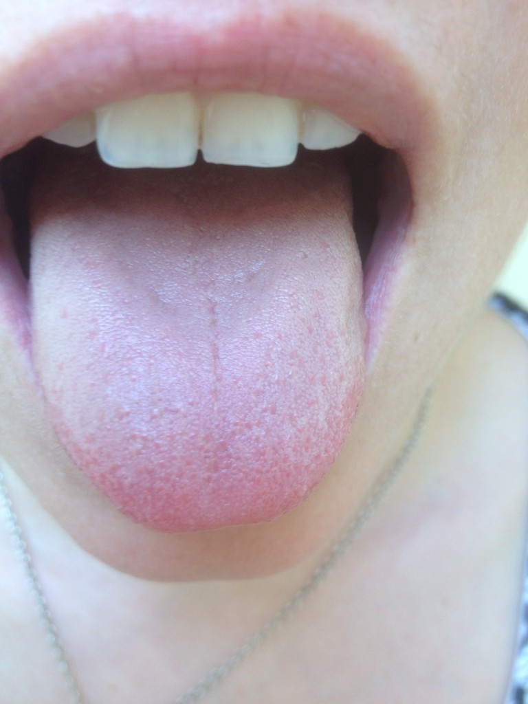 Tongue diagnosis in Acupuncture - Mairead Fahy | Body Matters